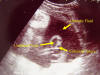 umbilical cord