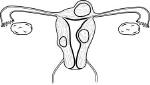 Uterine fibroids