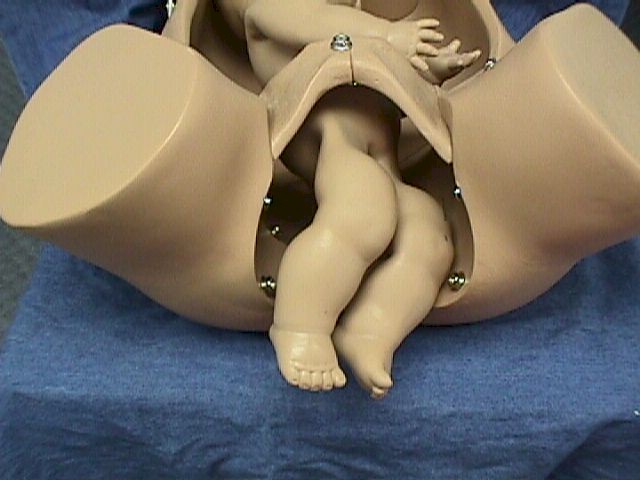 Footling Breech (Incomplete breech)