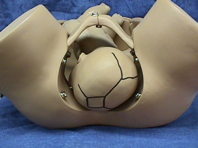 Left Occiput Anterior (LOA)