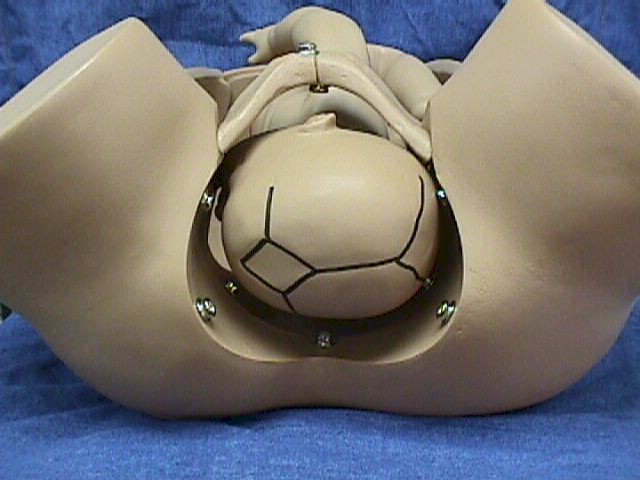 Left Occiput Transverse (LOT)