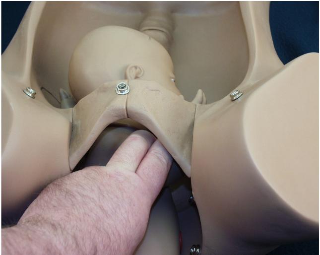 Reach the humerus and sweep it over the chest toward you.