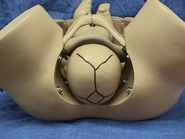 Occiput Anterior (OA)