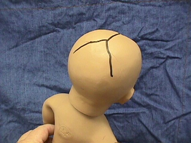 Posterior Fontanel