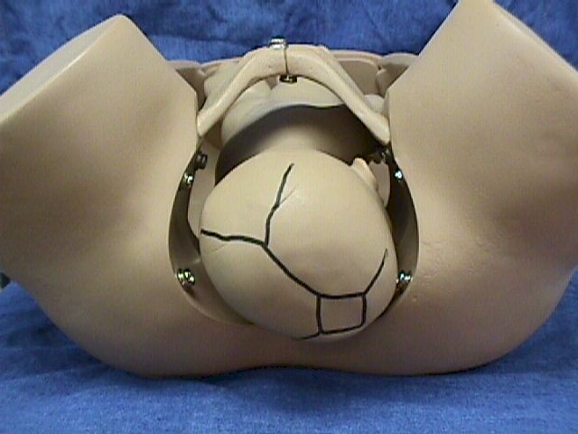 Right Occipuat Anterior (ROA)