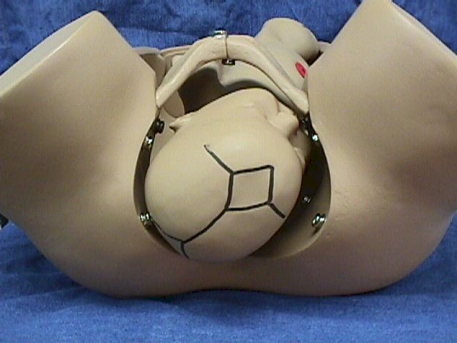 Right Occiput Posterior (ROP)