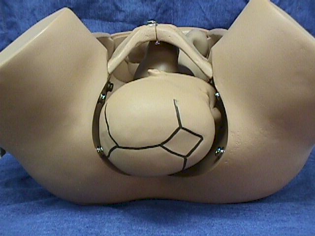 Right Occiput Transverse (ROT)