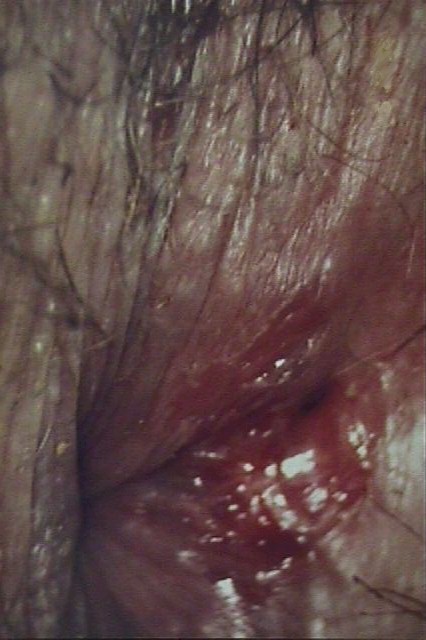 Rectal Laceration