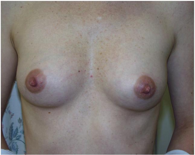 Two breasts are never identical