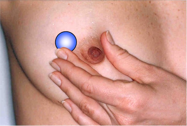 Breast Cyst