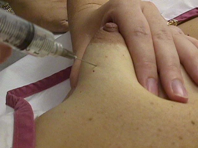 Breast Cyst Aspiration