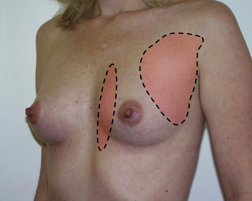 Non-cyclic Breast Pain