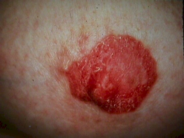 Paget's Disease of the Nipple