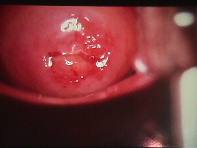 Apparently normal cervix