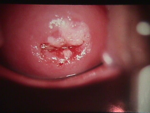 After application of acetic acid