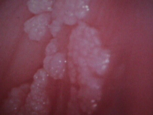Vaginal wall condyloma