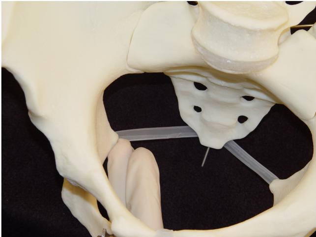 Palpate the ischial spine with your fingertip.