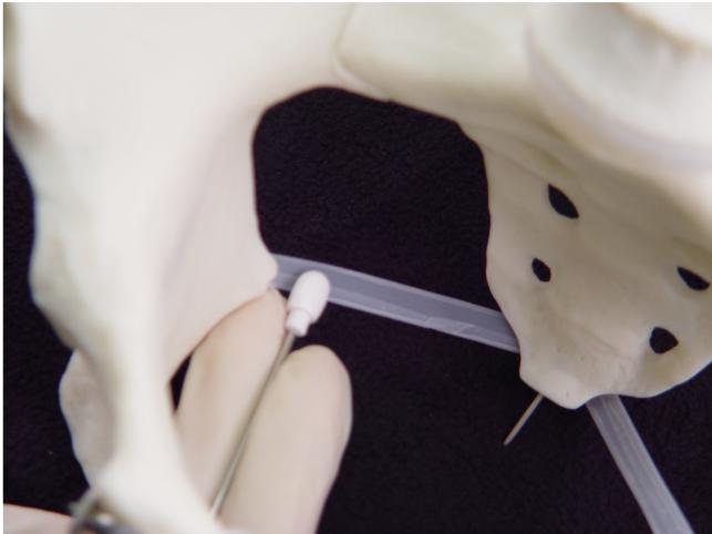 Place the Iowa Trumpet along the length of the sacrospinous ligament, about one cm from it's insertion onto the ischial spine.