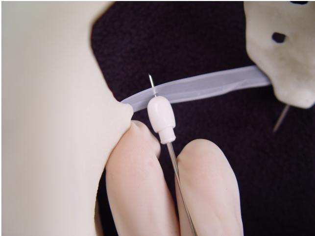 Using the Iowa Trumpet as a guide, insert the needle so that it perforates the sacrospinous ligament. Slowly infiltrating 10 cc of 1% lidocaine will effectively block the pudendal nerve as it courses (with the pudendal artery and vein) just beneath the sacrospinous ligament at this point.