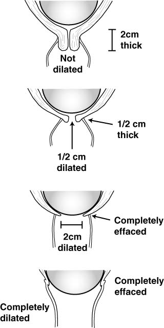 Cervical dilatation and effacement