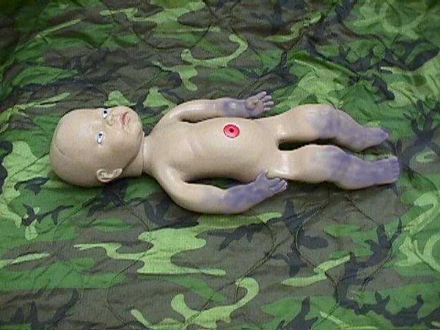Normal Acrocyanosis