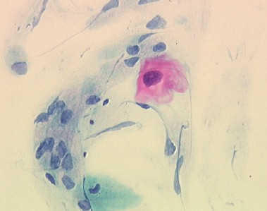 Atypical squamous cell (ASC-US)