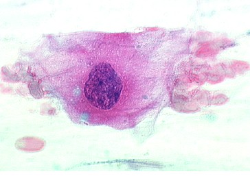 Atypical squamous cell (ASC-US)