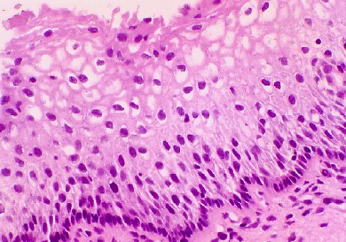 Cervical biopsy from above patient, showing low grade SIL