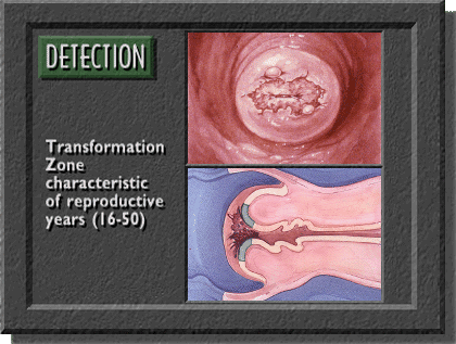 Transition zone in reproductive years