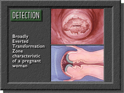 Transition zone during pregnancy