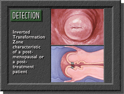 Transition zone in menopause