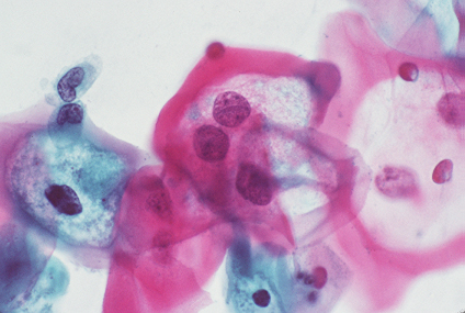 LSIL with koilocytosis suggestive of condyloma or HPV effect