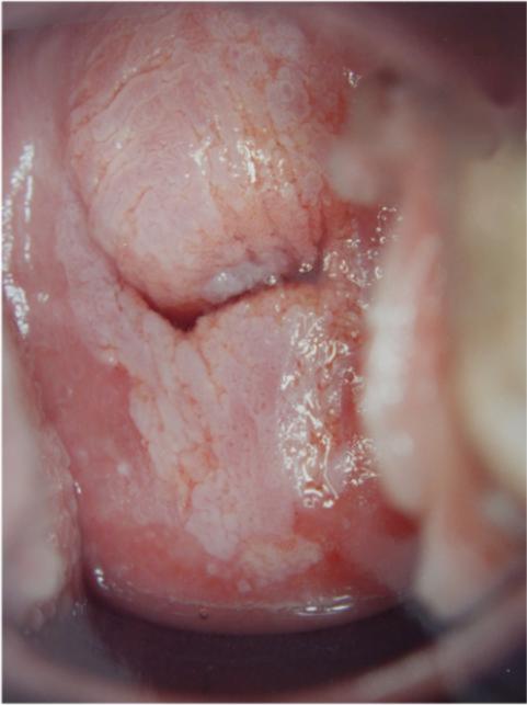 Severe Dysplasia