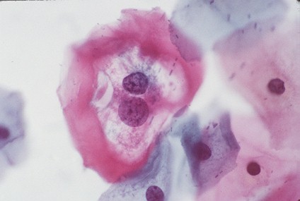 Koilocyte