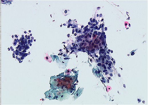 Severe Dysplasia or CIS