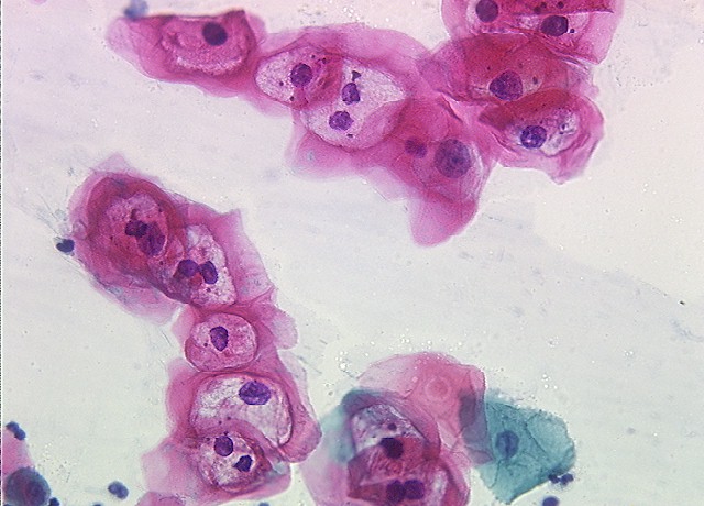 LSIL with koilocytosis suggestive of condyloma or HPV effect