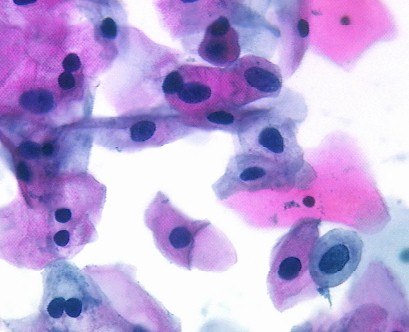 LSIL or Low grade squamous intraepithelial lesion