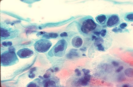 Severe Dysplasia or CIS