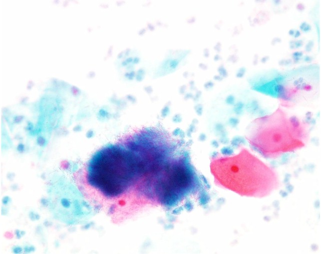 Actinomycosis