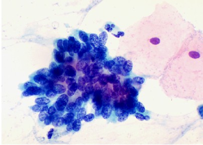 Adenocarcinoma of the cervix