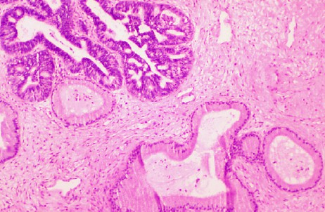 Adenocarcinoma in-situs of the cervix
