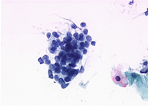 Severe dysplasia on Pap smear