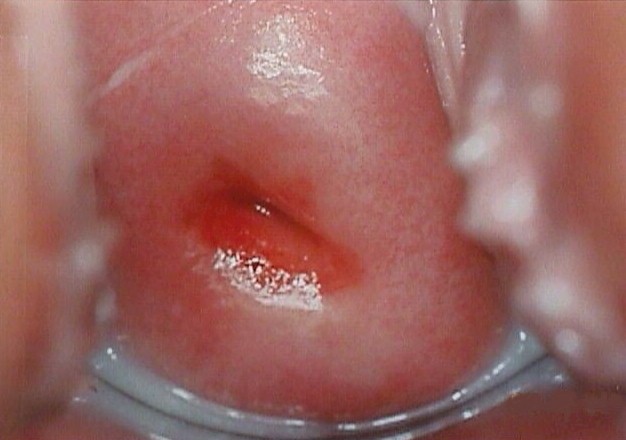 Initial normal appearance of mild dysplasia
