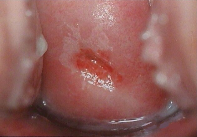 Mild Dysplasia after application of acetic acid