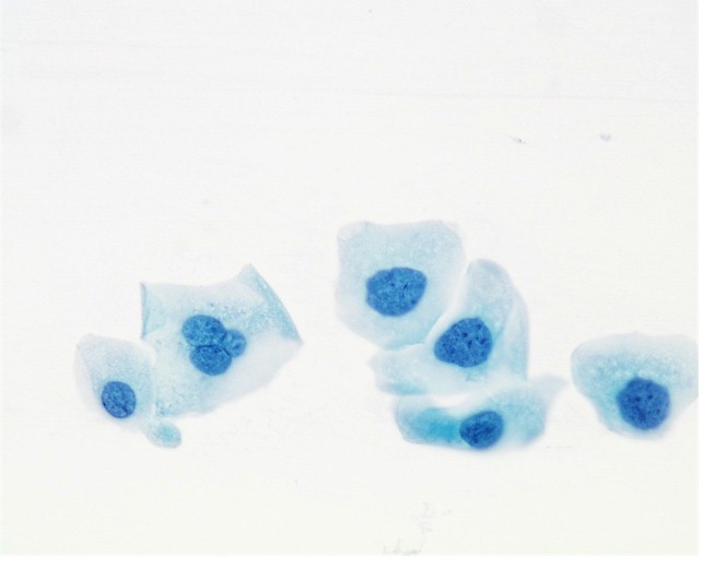 Moderate Dysplasia
