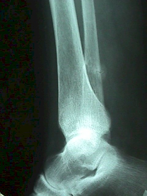 Fracture of a leg bone