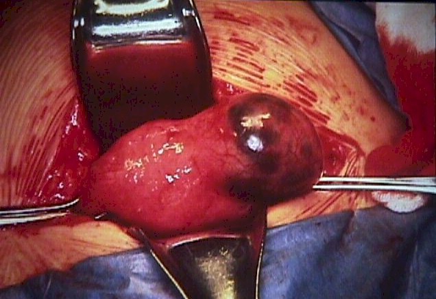 Unruptured cornual ectopic pregnancy
