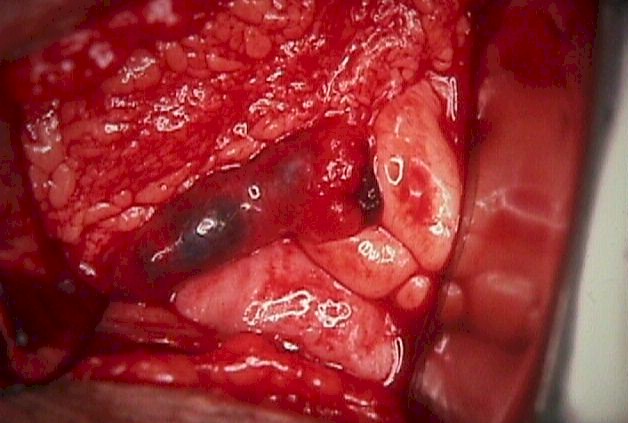 Unruptured tubal ectopic pregnancy