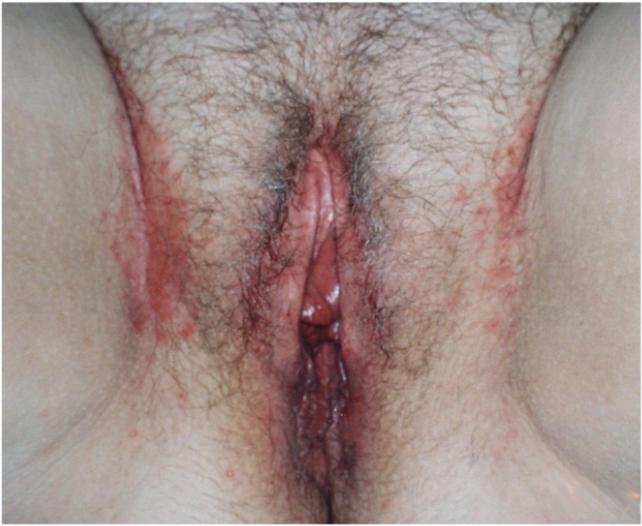 Tinea Cruris (Jock Itch)