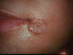 oralherpes.jpg (40872 bytes)